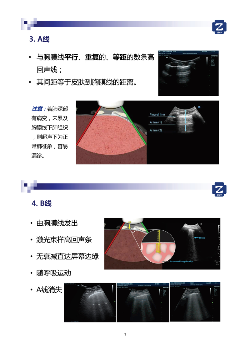 新冠肺超聲實(shí)用手冊(2)_35.jpg